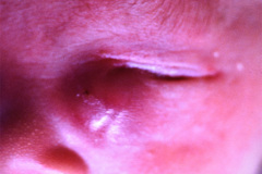 absceso-conducto-lacrimonasal-lagrimal-003