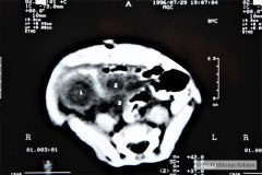 absceso-intrabdominal-tac-1996-000