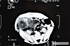 absceso-intrabdominal-tac-1996-001