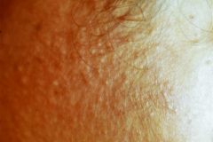 acne-adolescente-000