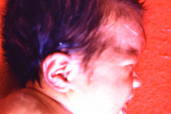 acondroplasia-1987-003