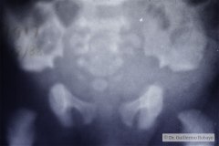 acondroplasia-1995-000