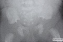 acondroplasia-2001-003