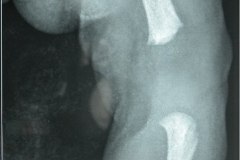 acondroplasia-2003-011