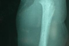 acondroplasia-2003-017
