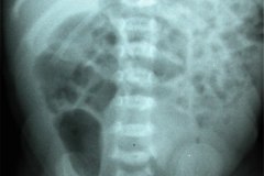 acondroplasia-003