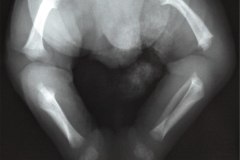 acondroplasia-004