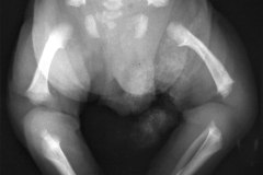 acondroplasia-005