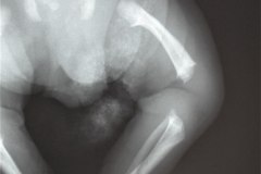 acondroplasia-011