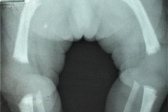 acondroplasia-2010-004