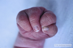 agenesia-3-dedo-mano-der-y-sindactilia-3-y-4-dedo-mano-izq-1990-001