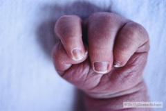 agenesia-3-dedo-mano-der-y-sindactilia-3-y-4-dedo-mano-izq-1990-002