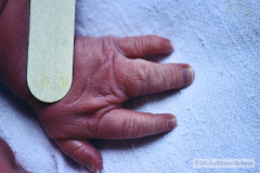 agenesia-3-dedo-mano-der-y-sindactilia-3-y-4-dedo-mano-izq-1990-003