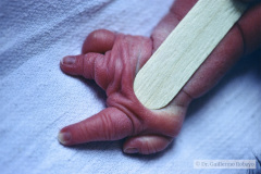 agenesia-3-dedo-mano-der-y-sindactilia-3-y-4-dedo-mano-izq-1990-004