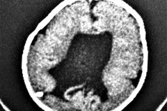 agenesia-cuerpo-calloso-hidrocefalia-tac-1985-000
