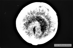 agenesia-cuerpo-calloso-tac-1996-001