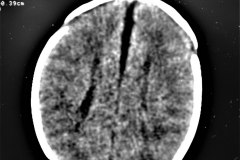 agenesia-cuerpo-calloso-tac-1997-001