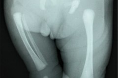 agenesia-femoral-der-1990-000