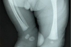 agenesia-femoral-der-1990-001