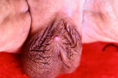 agenesia-pene-colostomia-1987-001