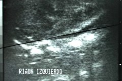 agenesia-renal-der-ecografia-1995-000