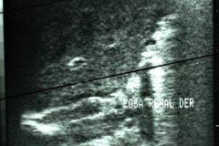 agenesia-renal-der-ecografia-1995-001