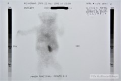 agenesia-renal-izq-renograma-1996-002