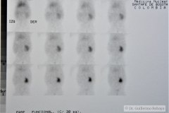 agenesia-renal-izq-renograma-2m-2000-000