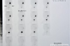 agenesia-renal-izq-renograma-2m-2000-001
