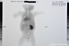 agenesia-renal-izq-renograma-2m-2000-002