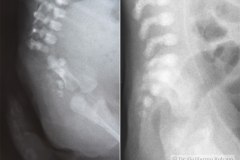 agenesia-sacro-diferencia-000