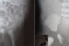 agenesia-sacro-diferencia-001