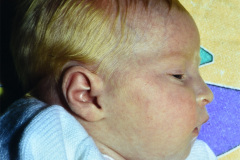 albinismo-1-m-1997-002
