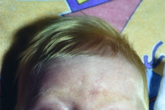 albinismo-1-m-1997-003