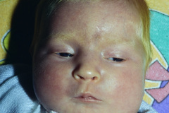 albinismo-1-m-1997-004