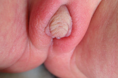 ambiguedad-genital-falo-seno-urogenital-vestigio-uretral-2005-001