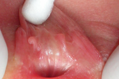 ambiguedad-genital-falo-seno-urogenital-vestigio-uretral-2005-007
