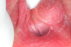 ambiguedad-genital-falo-seno-urogenital-vestigio-uretral-2005-008