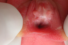 ambiguedad-genital-falo-seno-urogenital-vestigio-uretral-2005-009