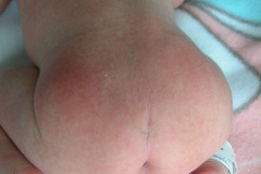 ambiguedad-genital-falo-seno-urogenital-vestigio-uretral-2005-011