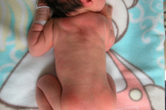 ambiguedad-genital-falo-seno-urogenital-vestigio-uretral-2005-012