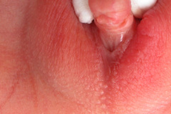 ambiguedad-genital-falo-seno-urogenital-vestigio-uretral-2005-013