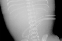 anasarca-cateteres-umbilical-art-femoral-ven-der-dialisis-2010-000