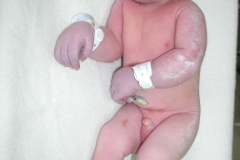 anencefalia-2004-002