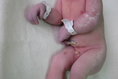 anencefalia-2004-003