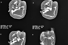 anencefalia-encefalocele-frontal-anoftalmia-der-tac-2000-001