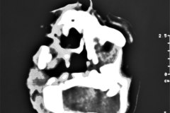 anencefalia-encefalocele-frontal-anoftalmia-der-tac-2000-003