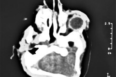 anencefalia-encefalocele-frontal-anoftalmia-der-tac-2000-005