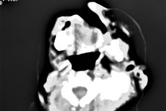 anencefalia-encefalocele-frontal-anoftalmia-der-tac-2000-006