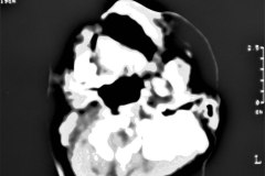 anencefalia-encefalocele-frontal-anoftalmia-der-tac-2000-007